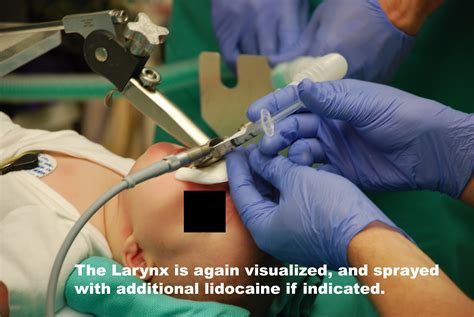 Laryngoscopy